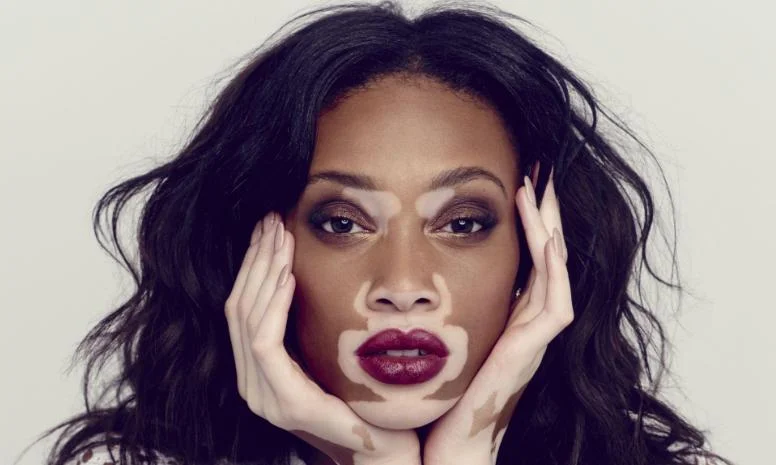 Winnie Harlow